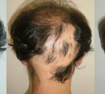 KURA NATYRALE PËR LUFTIMIN E ALOPECIAS ANDROGJENIKE KURA NATYRALE PËR LUFTIMIN E ALOPECIAS ANDROGJENIKE