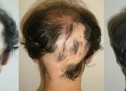 KURA NATYRALE PËR LUFTIMIN E ALOPECIAS ANDROGJENIKE KURA NATYRALE PËR LUFTIMIN E ALOPECIAS ANDROGJENIKE